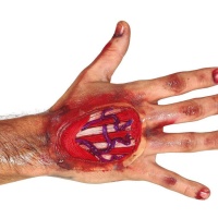 Cicatriz de tendones de mano con adhesivo